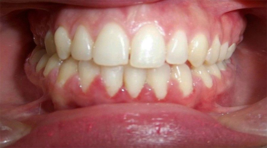 After Orthodontics and dental treatment at Dr. Ayman Al-Ghamrawi Center - Dental implants and cosmetics 5